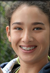 stock photo of a girl with braces 